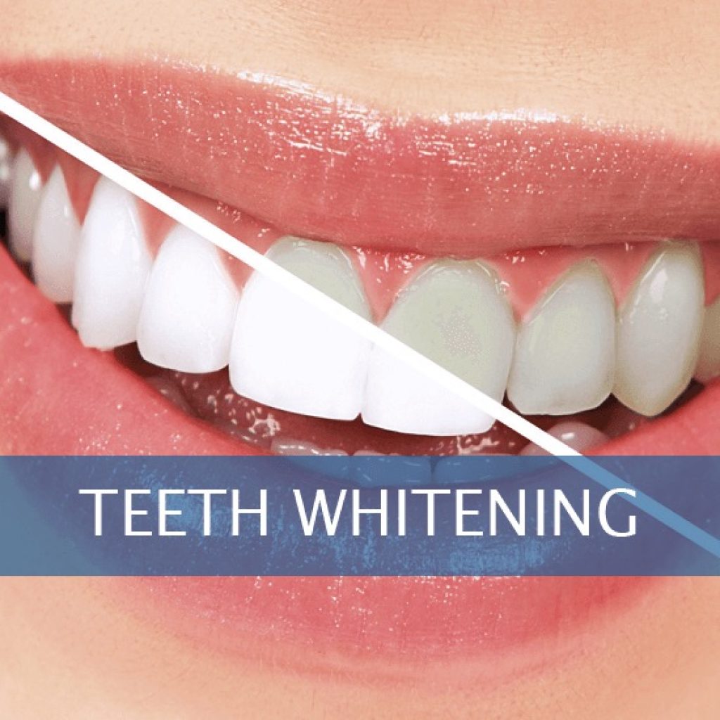 Teeth whitening - Pearl MedSpa